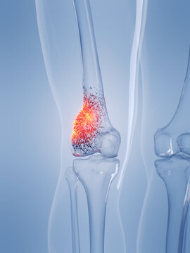 A Detailed 3D Depiction Of Osteosarcoma In A Human Male