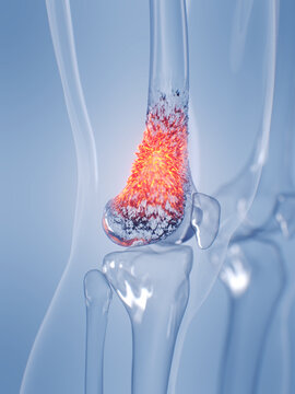 A Detailed 3D Depiction Of Osteosarcoma In A Human Male