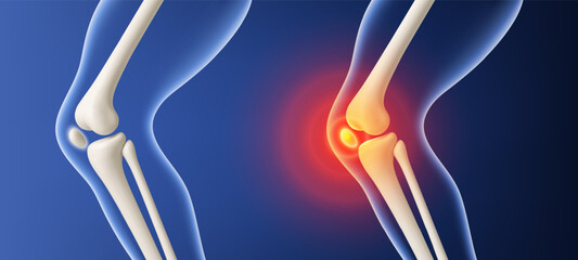 Healthy and painful knee joint comparison. Vector realistic illustration