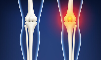 Healthy and painful knee joint comparison. Vector realistic illustration