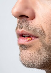 Fototapeta premium Closeup of a man with herpes sore on his lip. Cold sores on lower lip. Medical concept. Health problem.