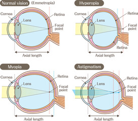 Structure of the Eye and Refractive Errors Diagram