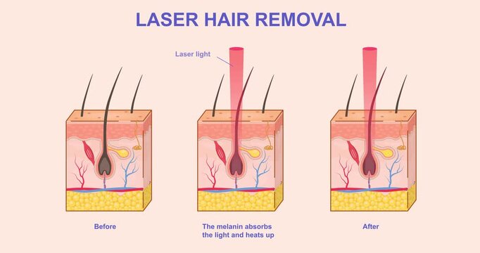 Laser hair removal. Moving banner showing layers of skin and process of hair removal using laser beam. Infographic showing cosmetic procedure. Flat graphic animated cartoon