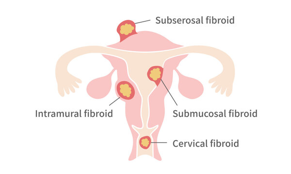 Types of Uterine Fibroids &ndash; Intramural, Submucosal, Subserosal, and Cervical Fibroids