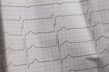 Medical chart shows heart activity with graph lines and grid pattern during a health check at a hospital in the afternoon