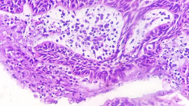 Tissue from left auricle. Carcinoma in situ with microinvasion. Histopathology microscopic image. 