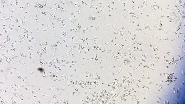 Sperm analysis on microscopic examination, Normozoospermia, normal semen analysis.