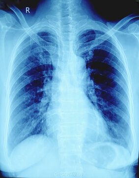 X-ray of human chest. Suggestive of pneumonitis.