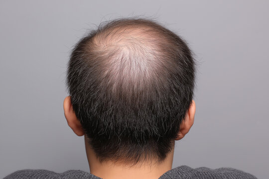 Back view of a man's head showing hair loss and crown thinning, male pattern baldness concept isolated on grey background