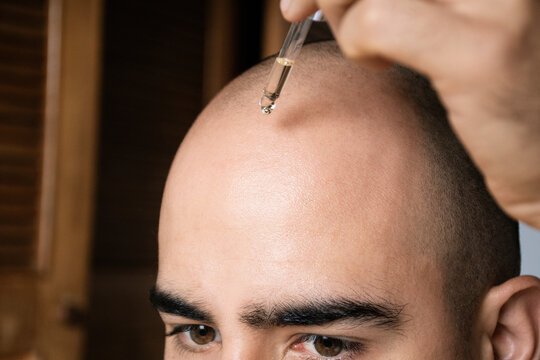 Applying Hair Serum on Bald Scalp for Hair Growth Treatment
