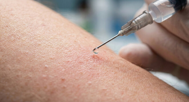 Macro shot of syringe needle tip with clear liquid drop for intradermal injection and mesotherapy treatment.