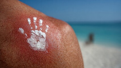 Fototapeta premium Person applies sun cream with sun symbol on shoulder at beach