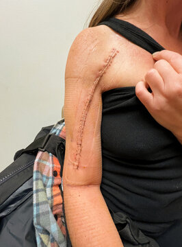 Close-up of fracture surgery scar after staple removal