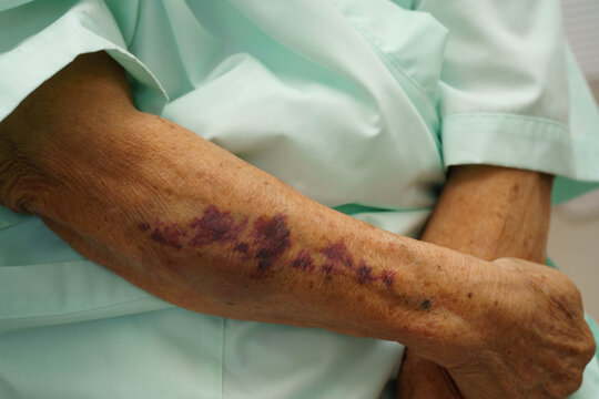 Ecchymosis, elderly bleeding on her arm after taking aspirin.