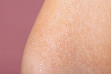Fototapeta premium Closeup of skin detail highlighting natural stretch marks texture