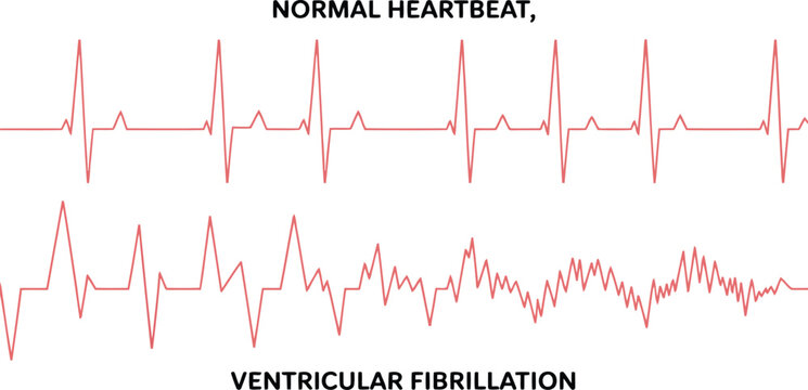 Detailed medical illustration comparing a healthy normal heartbeat rhythm with chaotic ventricular fibrillation displayed on an ECG graph