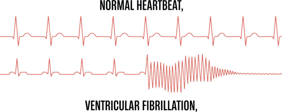 Dynamic medical representation displaying a normal heartbeat rhythm abruptly changing into chaotic ventricular fibrillation on an ECG