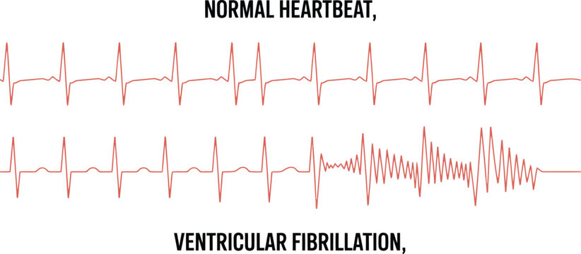 Medical visualization illustrating the clear distinction between a steady normal heartbeat and the onset of ventricular fibrillation on an ECG