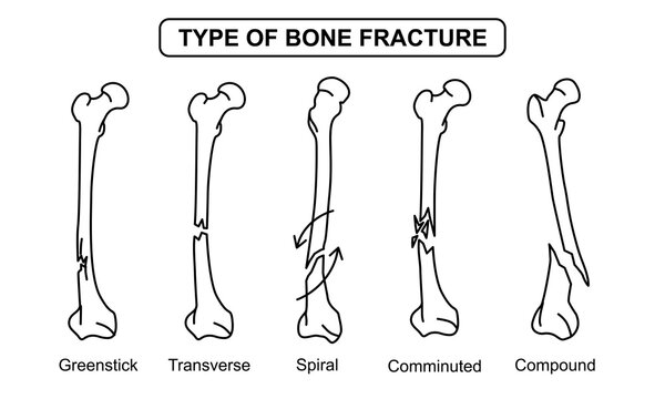 Medical Illustration of Type of Bone Fracture, greenstick, transverse, spiral, comminuted, compound, osteoporosis bone. vector drawing illustration for medical, poster and education.