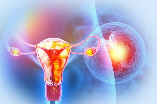 Uterus or uterine cancer. Medical concept as cancerous cells spreading in a female reproductive system. 3d illustration
