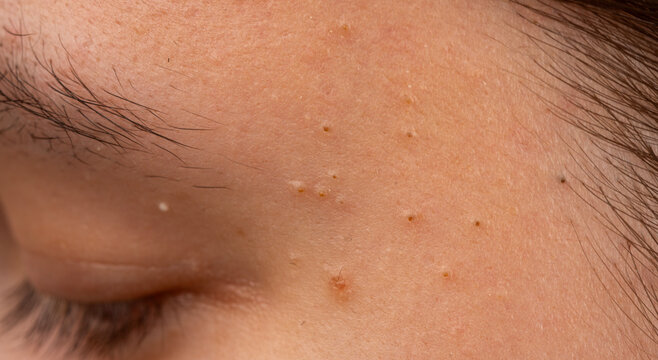 Acne close up on forehead skin with pimple and pores texture. Skin detail with comedone whitehead. Acne blemish and pores for dermatology. Close up skin problem with sebum and acne.