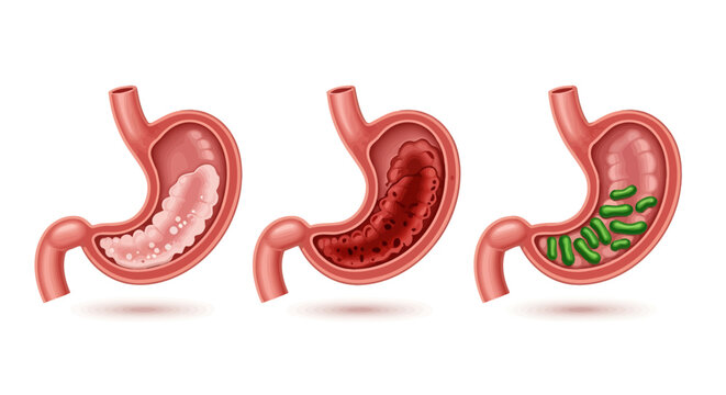 Crosssection of Human Stomach Showing Different Stages of Digestion.