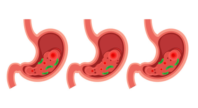 Illustration of a Human Stomach Showing Digestion Process.