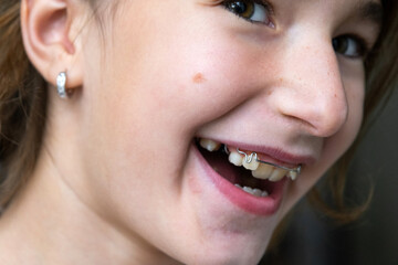 Naklejka premium Close-up girl's mouth, visible orthodontic plate, pediatric correction for dental arch and healthy bite.