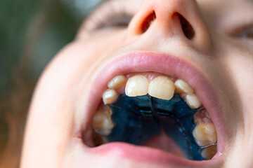 Upper jaw close-up, visible orthodontic plate, pediatric correction of bite and teeth arch. © Ольга Симонова