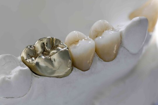 Zahnersatz mit Keramikkronen und Goldkrone auf dem Model
