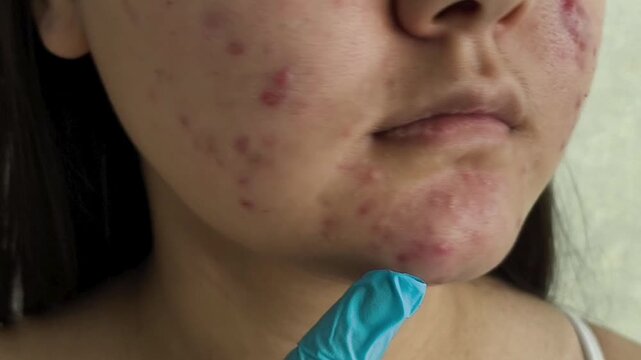 A hand in blue medical gloves touches, points to acne, pimples on the face of a teenage girl. Doctor examining patient with problem skin