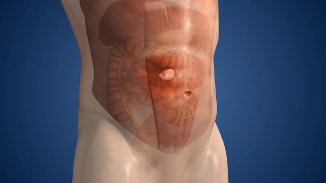 Epigastric Hernia Formation in Upper Abdomen