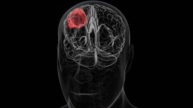 Brain Cancer (Meningioma) in Vertical HQ Video | Brain Cancer (Meningioma) Indication X-Ray Video