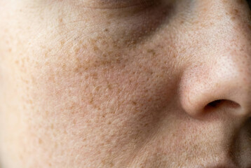 Fototapeta premium Extreme close up of human skin with freckles, natural texture and skincare concept .generative AI