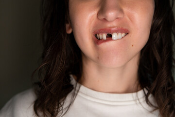Mature Caucasian brunette woman missing a front tooth.