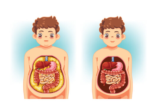 Visceral Fat vs Healthy Abdomen Comparison