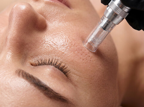 Close-up of cosmetic microneedling pen treatment on woman's face for skin rejuvenation and anti-aging 