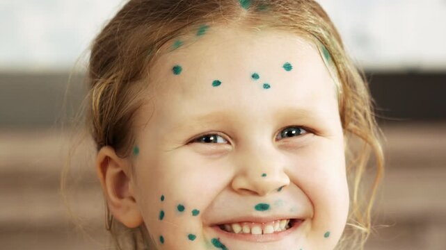 Funny portrait of a little girl suffering from chickenpox at home, blisters on her face treated with antiseptic ointment. The child easily tolerates the disease. Varicella.
