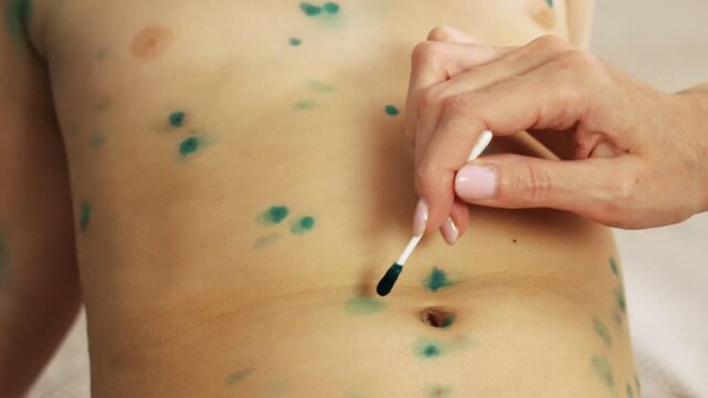 A mother treats her little daughter for chickenpox at home, she treats blisters on the child's body with antiseptic ointment. Chicken pox. Close-up.