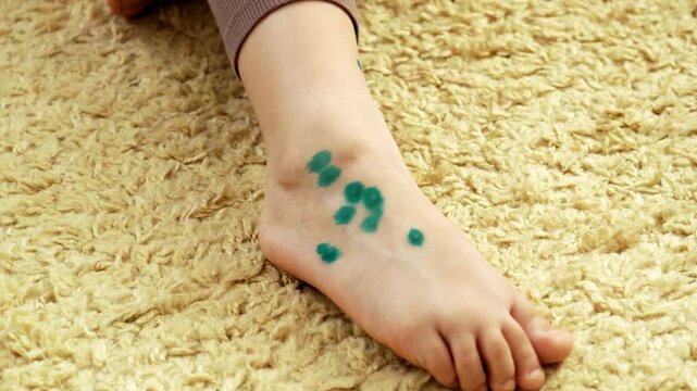 A close-up of the legs of a little girl suffering from chickenpox at home, with blisters treated with antiseptic ointment. Varicella.