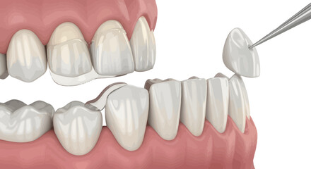 Dental prosthesis being placed on a set of artificial gums and teeth from a close-up viewpoint
