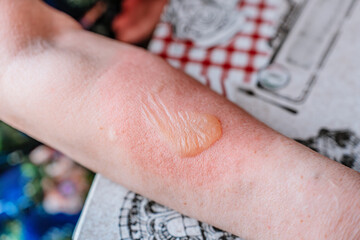 Burned hand with blister and red skin, medical imagery useful for dermatology education © KseniaJoyg