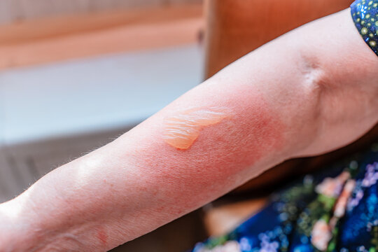 Burned hand with blister and red skin, medical imagery useful for dermatology education