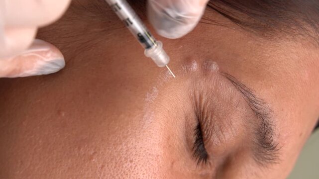 Vertical video of professional doctor performing botulinum toxin injection near female patient eye area for crow feet wrinkle correction in aesthetic beauty clinic