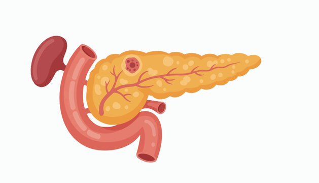 Pancreatic Cancer Medical Flat Vector with Tumor Highlight