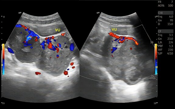 Transabdominal ultrasound imaging of the uterus demonstrates a well-defined intrauterine mass with internal vascularity on color Doppler evaluation, suggestive of a solid uterine lesion requiring furt