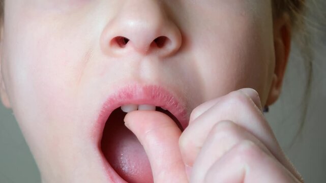 7 years old girl moves loose milk tooth with finger. Close up of open mouth with loose milk tooth. Girl presses on loose milk tooth with finger. Concept of losing milk teeth. Dental care.