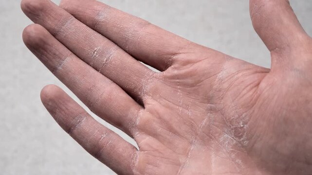 Man shows palm with dry, cracked skin. Problem of damaged skin. Close up view on dry skin or eczema on hand. Health care concept.