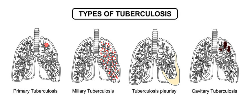 Types of Tuberculosis in Human Lungs, Primary, Miliary, Pleural and Cavitary Tuberculosis. Line drawing vector illustration for education, medical awareness campaign, science, and medical poster.