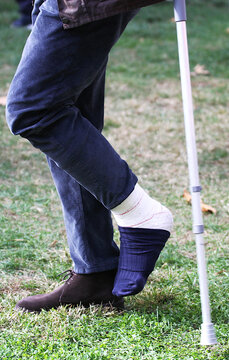 Muletas y escayola en pie inmovilizado y operado por lesi&oacute;n